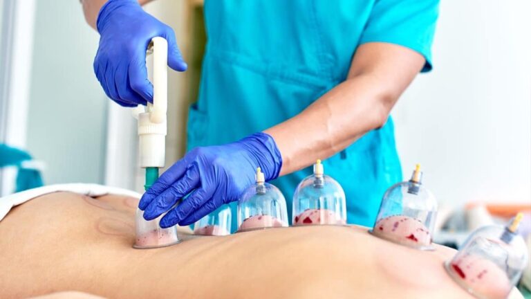 hijama-cupping-therapy-image